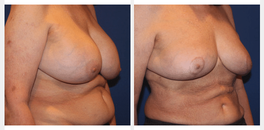 Before and after images of a fat transfer to breast
