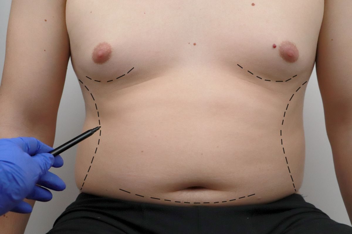Male Breast Reduction