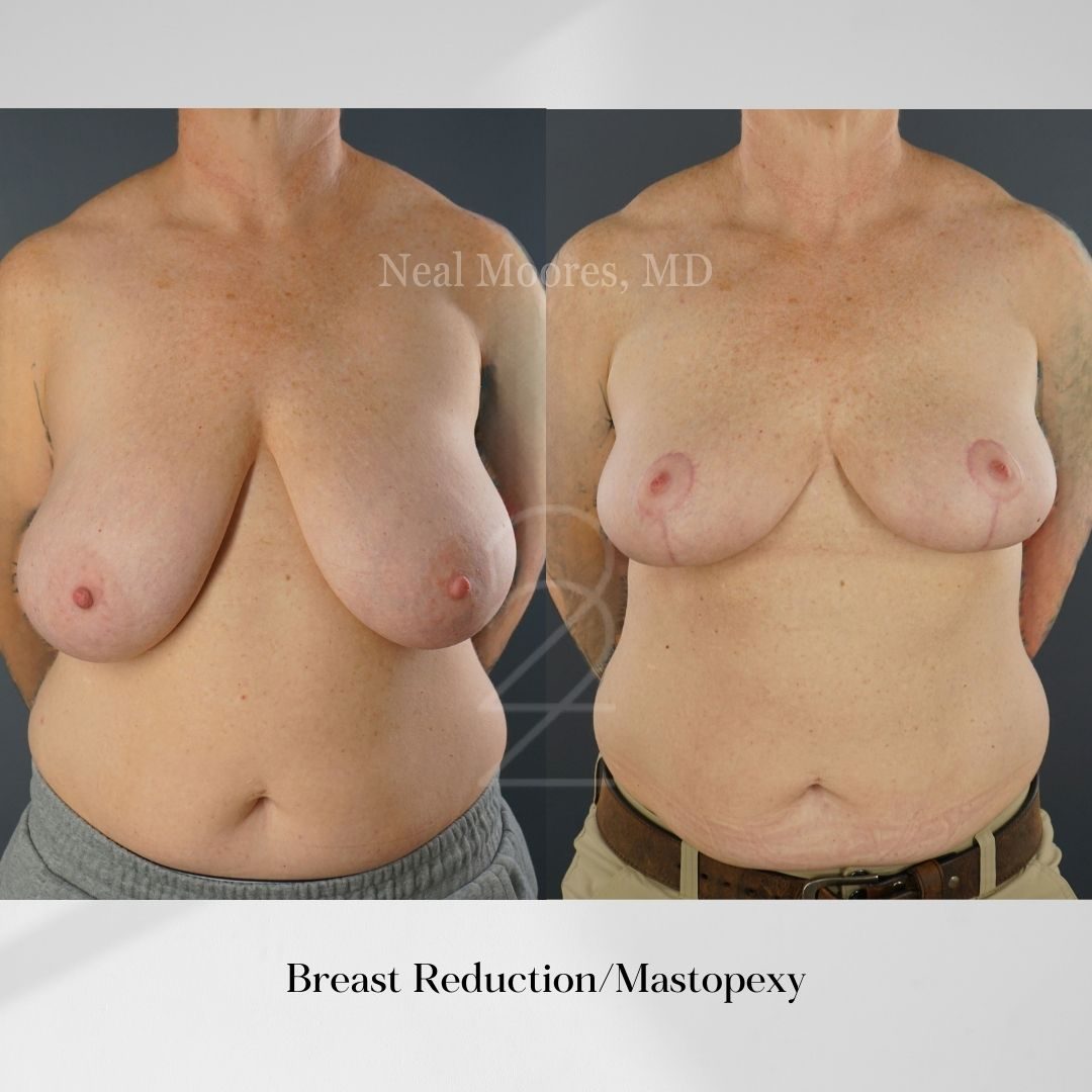 Breast Lift - 22 Plastic Surgery