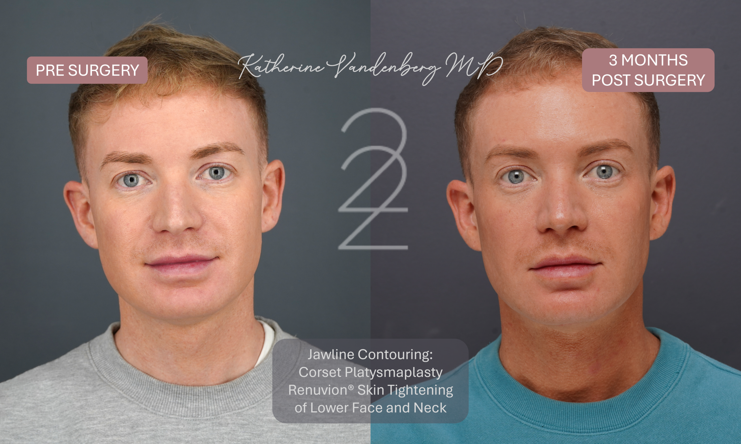 Before and 3 months after male jawline contouring with corset platysmaplasty and Renuvion® skin tightening, showing improved jawline definition, a sharper cervicomental angle, and a smoother, firmer neck contour. Performed by Dr. Katherine Vandenberg in Salt Lake City, Utah.