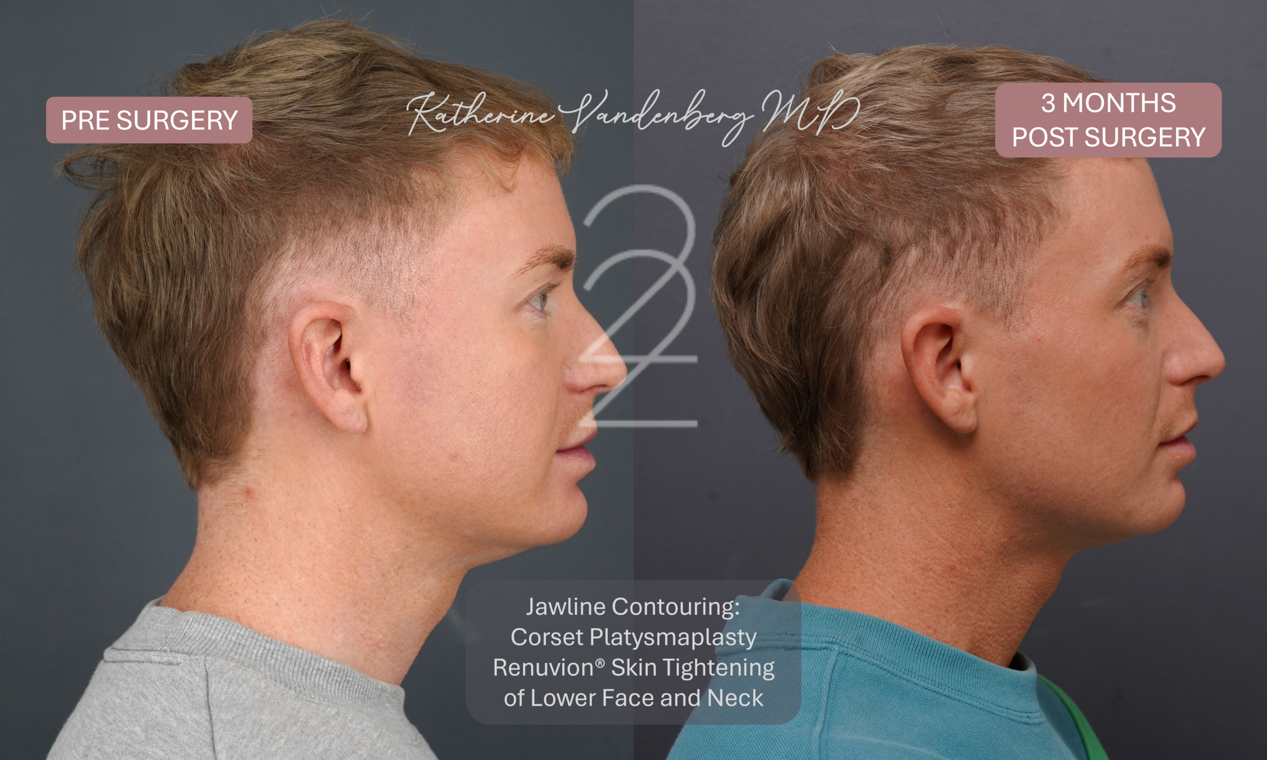 Before and 3 months after male jawline contouring with corset platysmaplasty and Renuvion® skin tightening, showing improved jawline definition, a sharper cervicomental angle, and a smoother, firmer neck contour. Performed by Dr. Katherine Vandenberg in Salt Lake City, Utah.