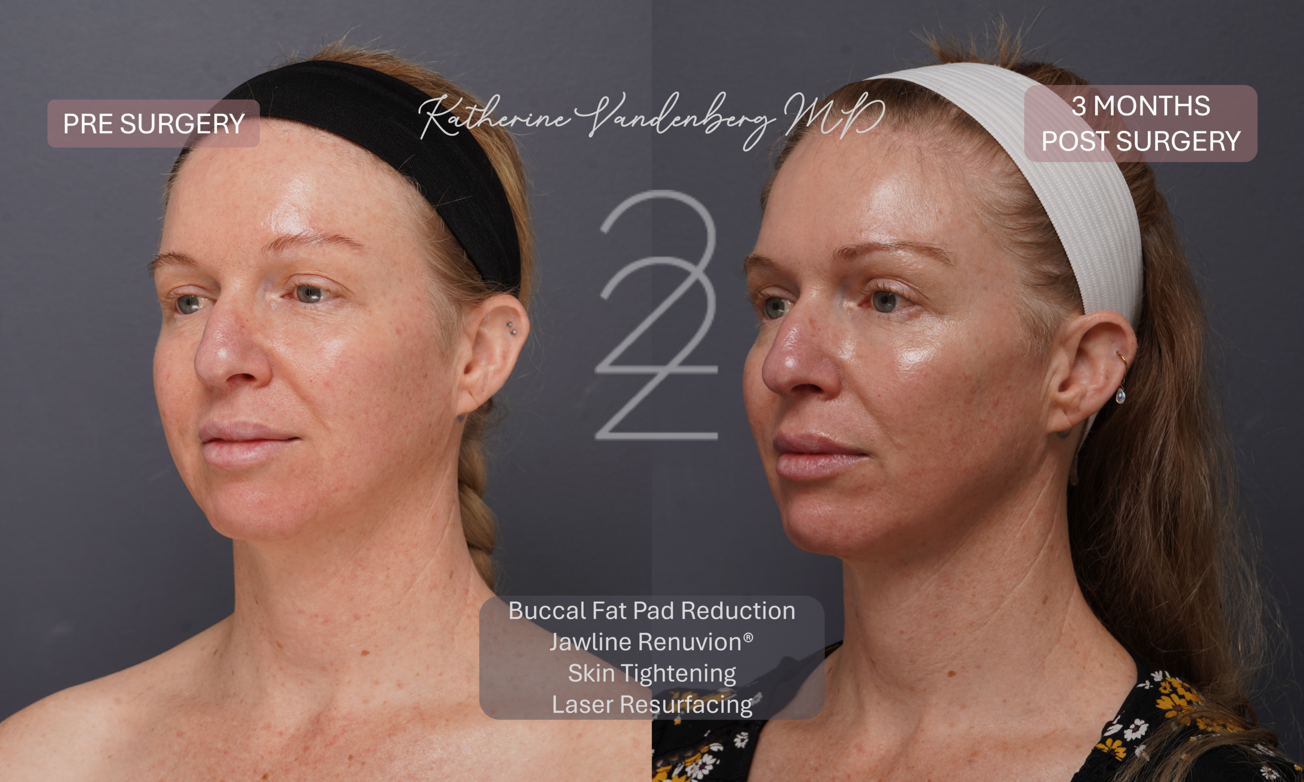 Before and 3 months after female jawline contouring with buccal fat pad reduction, Renuvion® skin tightening, and laser resurfacing, showing improved jawline definition, enhanced cheekbone projection, smoother skin texture, and a more radiant complexion.