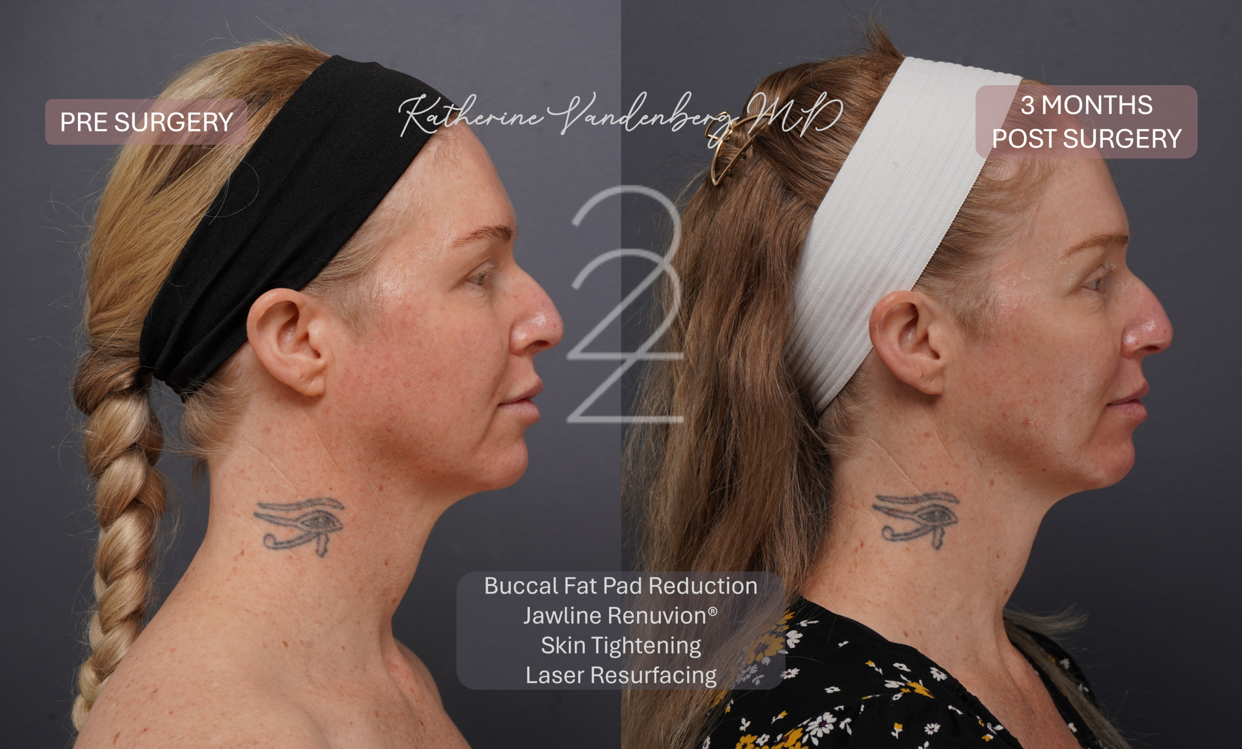 Before and 3 months after female jawline contouring with buccal fat pad reduction, Renuvion® skin tightening, and laser resurfacing, showing improved jawline definition, enhanced cheekbone projection, smoother skin texture, and a more radiant complexion.
