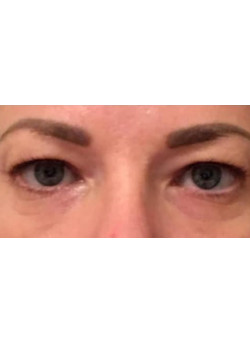 Eyelid & Brow Surgery