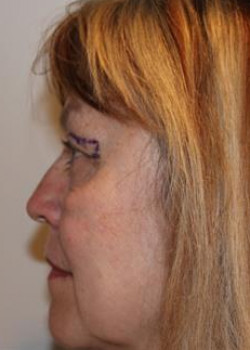 Eyelid & Brow Surgery