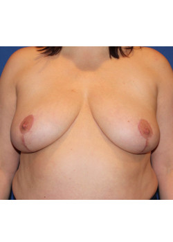 Breast Reduction & Breast Lift