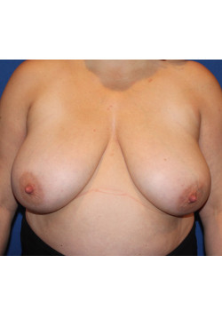 Breast Reduction & Breast Lift