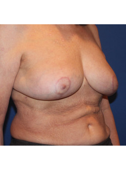 En Bloc Capsulectomy / Breast Lift / Fat Transfer to Breast