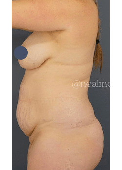 Liposuction 360